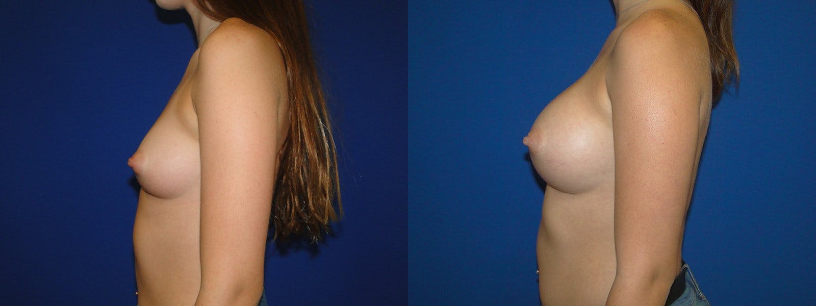Breast Augmentation Before & After Gallery - Patient 74801827 - Image 2