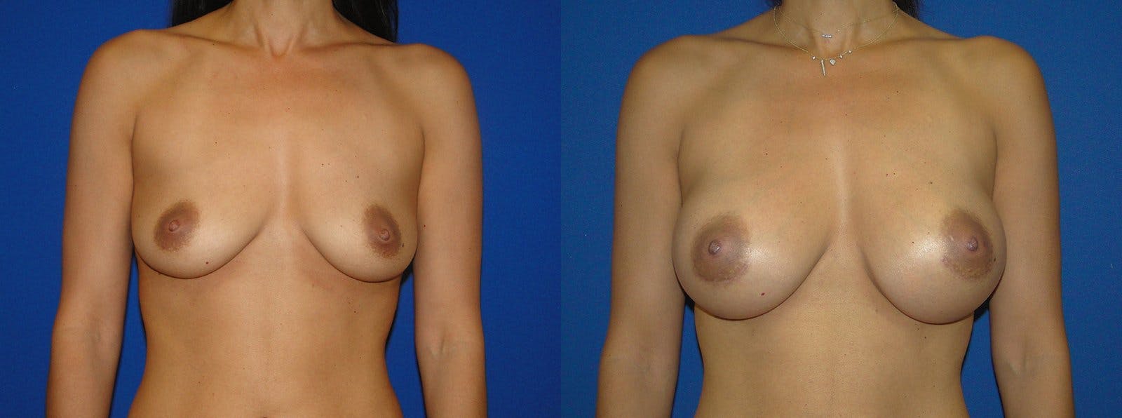 Breast Augmentation Before & After Gallery - Patient 74801828 - Image 1