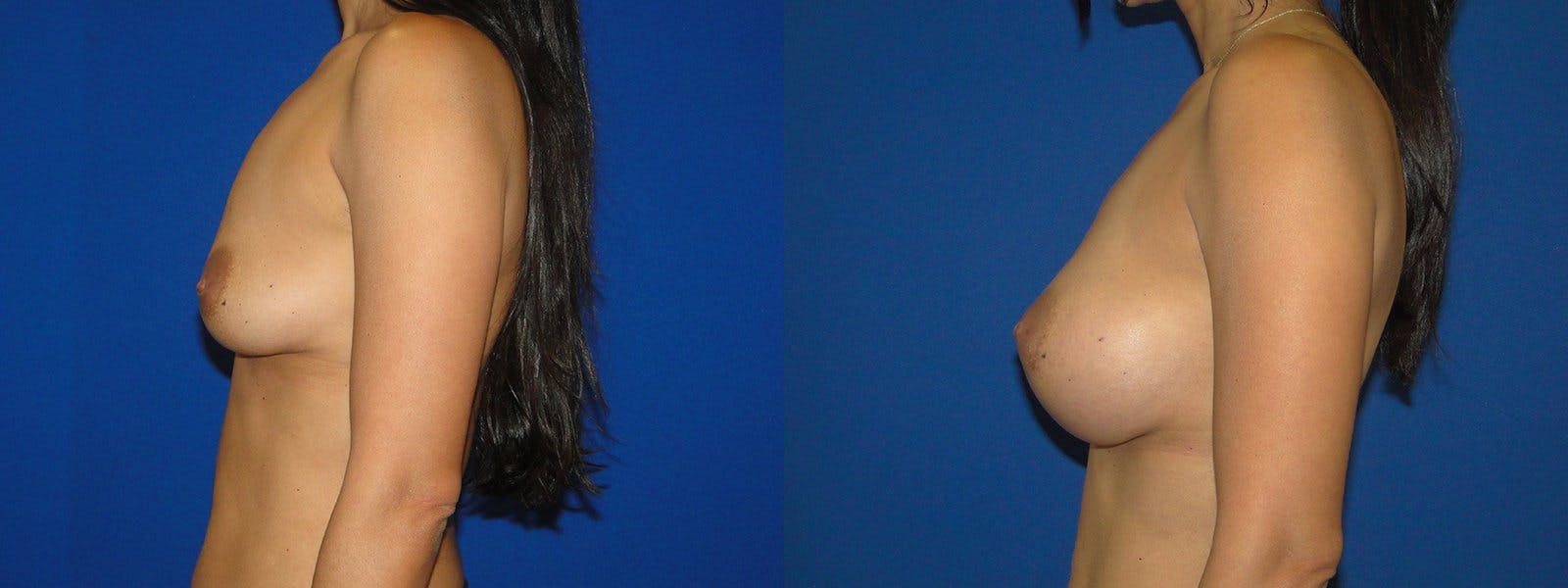 Breast Augmentation Before & After Gallery - Patient 74801828 - Image 2