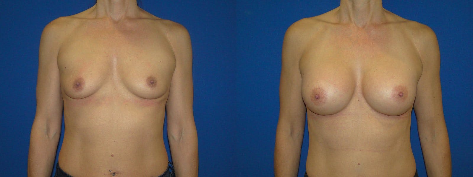 Breast Augmentation Before & After Gallery - Patient 74801829 - Image 1