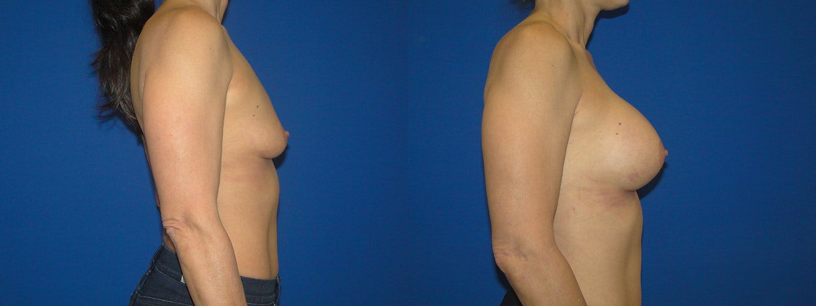 Breast Augmentation Before & After Gallery - Patient 74801829 - Image 2