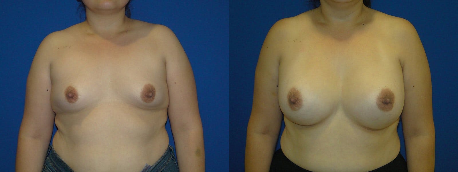 Breast Augmentation Before & After Gallery - Patient 74801830 - Image 1
