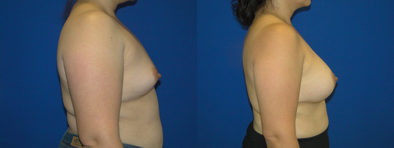 Breast Augmentation Before & After Gallery - Patient 74801830 - Image 2