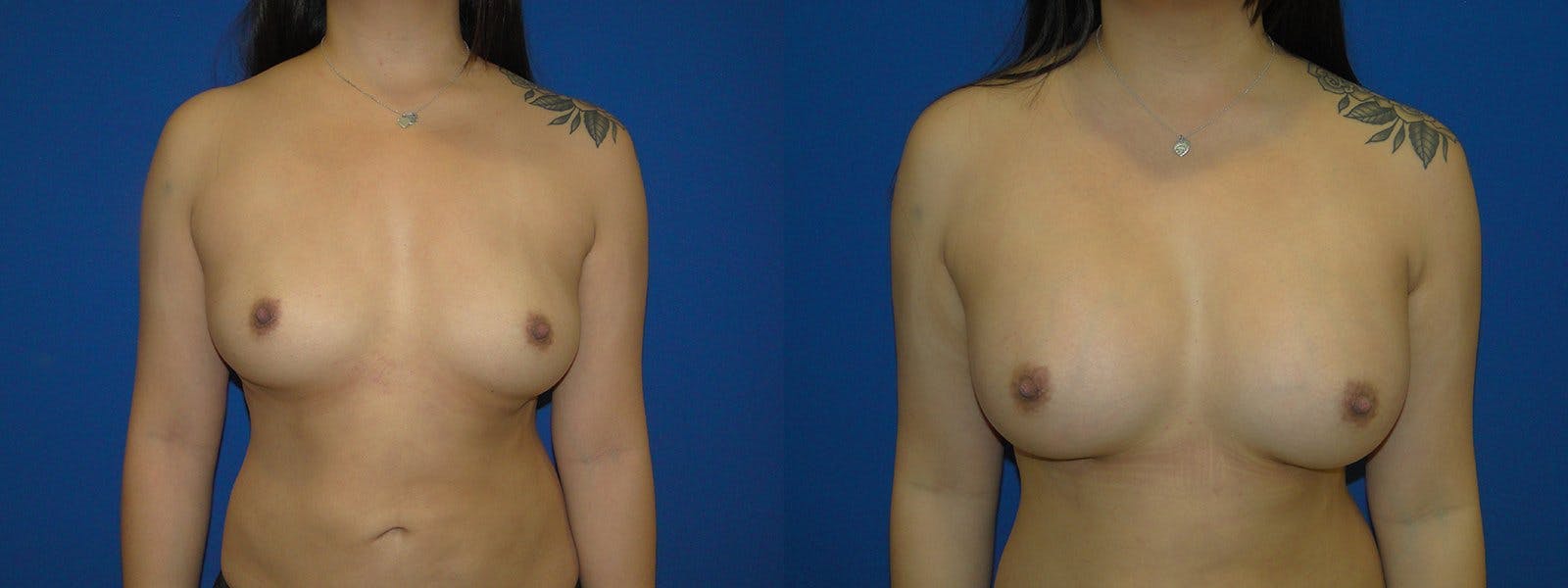 Breast Augmentation Before & After Gallery - Patient 74801831 - Image 1