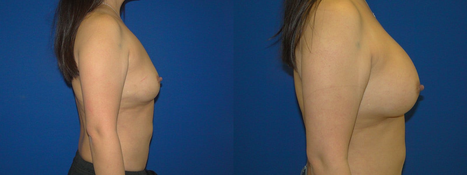 Breast Augmentation Before & After Gallery - Patient 74801831 - Image 2