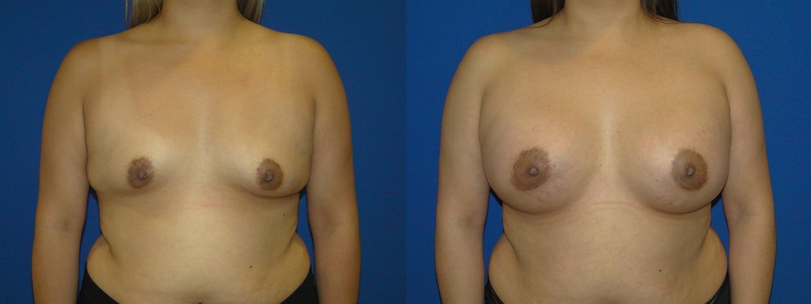 Breast Augmentation Before & After Gallery - Patient 74801832 - Image 1