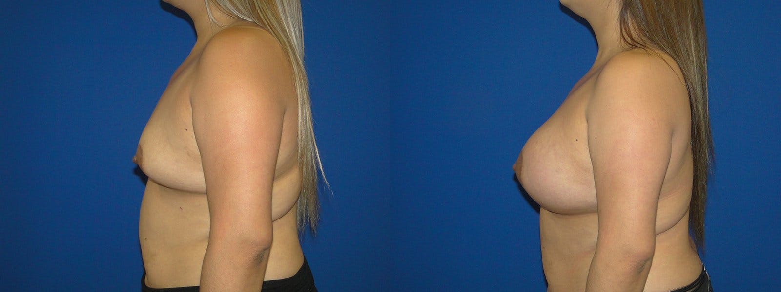 Breast Augmentation Before & After Gallery - Patient 74801832 - Image 2