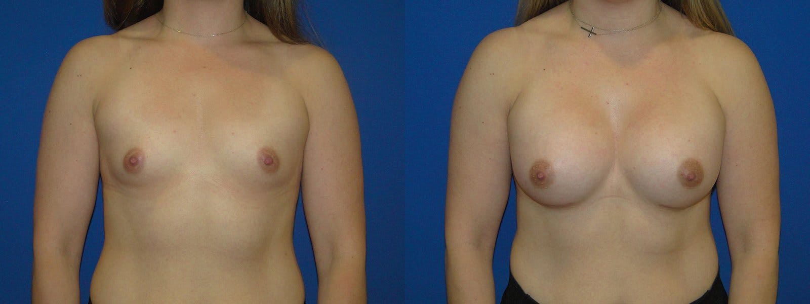 Breast Augmentation Before & After Gallery - Patient 74801833 - Image 1