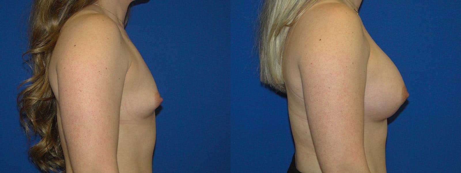 Breast Augmentation Before & After Gallery - Patient 74801833 - Image 2