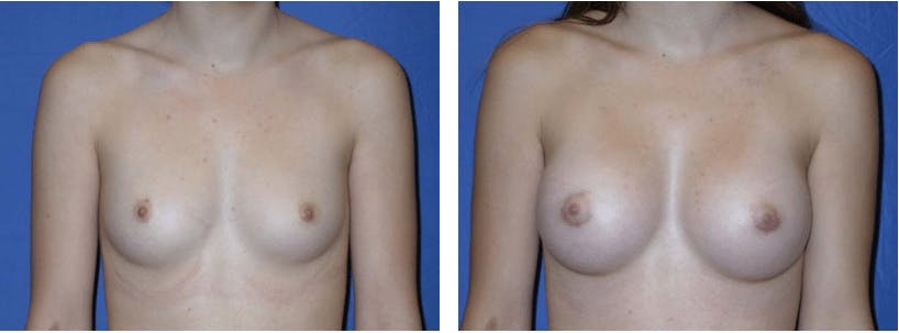 Breast Augmentation Before & After Gallery - Patient 74801834 - Image 1