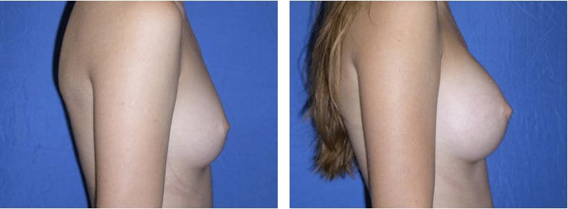Breast Augmentation Before & After Gallery - Patient 74801834 - Image 2