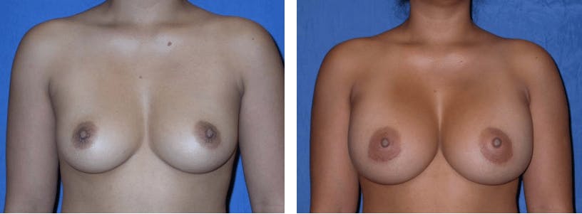Breast Augmentation Before & After Gallery - Patient 74801835 - Image 1