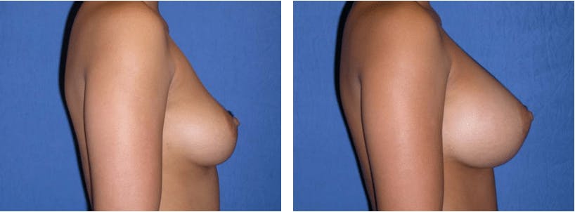 Breast Augmentation Before & After Gallery - Patient 74801835 - Image 2