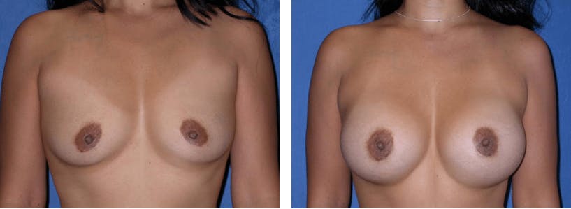 Breast Augmentation Before & After Gallery - Patient 74801836 - Image 1
