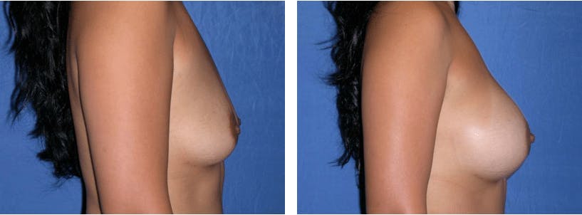 Breast Augmentation Before & After Gallery - Patient 74801836 - Image 2