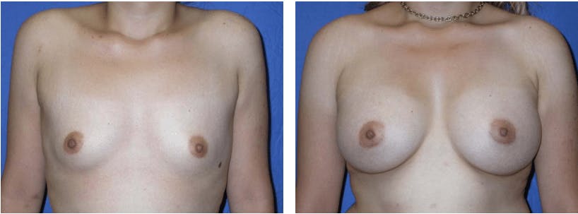 Breast Augmentation Before & After Gallery - Patient 74801837 - Image 1