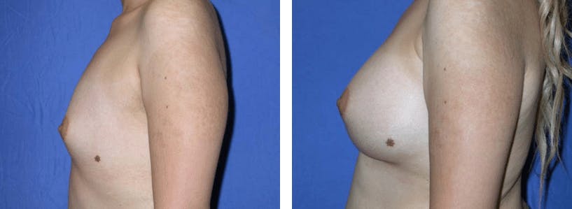 Breast Augmentation Before & After Gallery - Patient 74801837 - Image 2