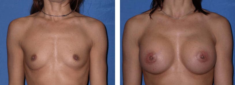 Breast Augmentation Before & After Gallery - Patient 74801838 - Image 1