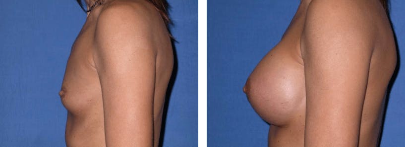 Breast Augmentation Before & After Gallery - Patient 74801838 - Image 2