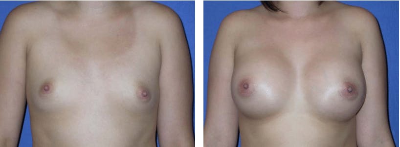 Breast Augmentation Before & After Gallery - Patient 74801839 - Image 1