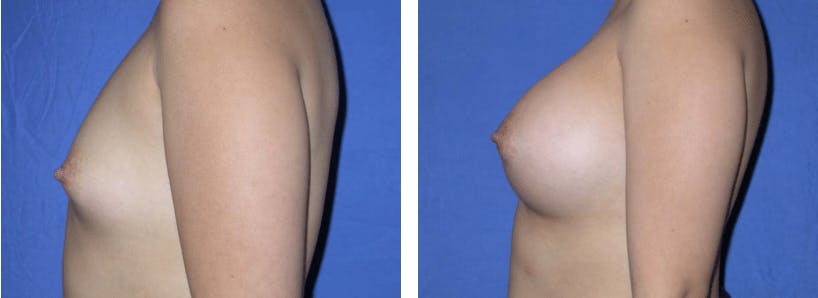 Breast Augmentation Before & After Gallery - Patient 74801839 - Image 2