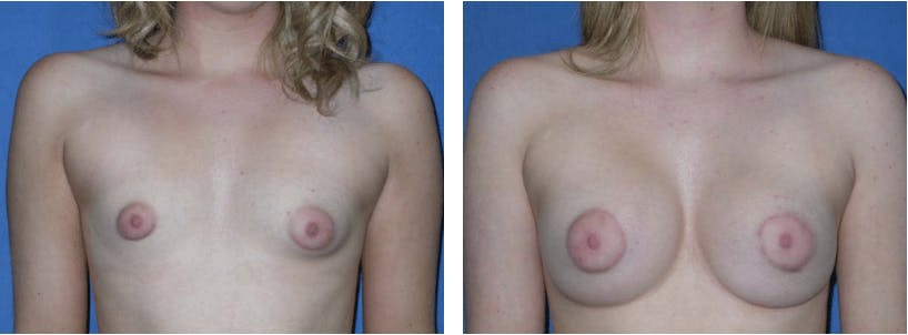 Breast Augmentation Before & After Gallery - Patient 74801840 - Image 1
