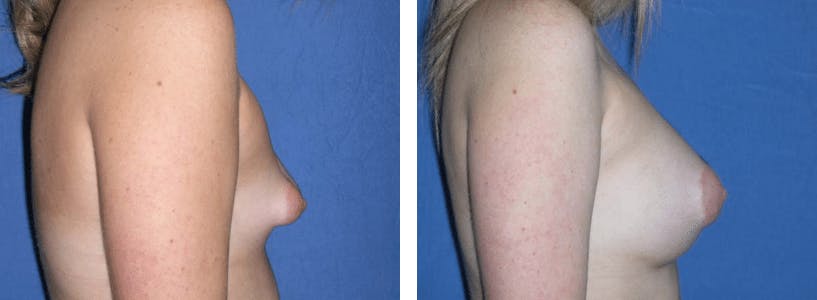 Breast Augmentation Before & After Gallery - Patient 74801840 - Image 2
