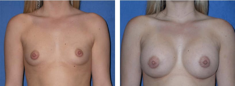 Breast Augmentation Before & After Gallery - Patient 74801843 - Image 1