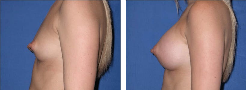 Breast Augmentation Before & After Gallery - Patient 74801843 - Image 2