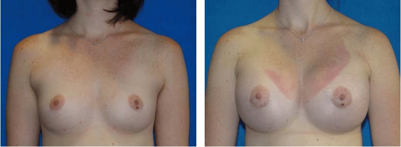 Breast Augmentation Before & After Gallery - Patient 74801844 - Image 1