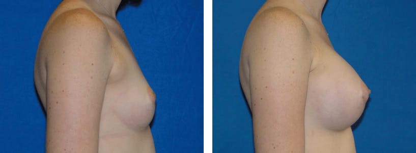 Breast Augmentation Before & After Gallery - Patient 74801844 - Image 2