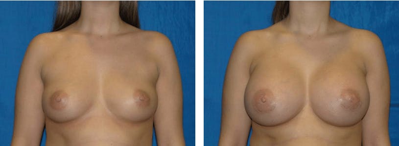 Breast Augmentation Before & After Gallery - Patient 74801846 - Image 1