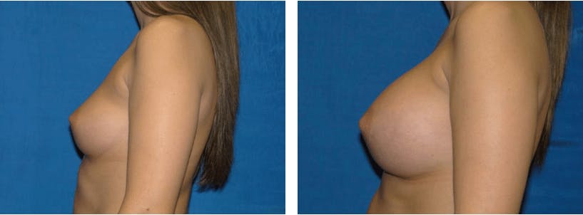 Breast Augmentation Before & After Gallery - Patient 74801846 - Image 2