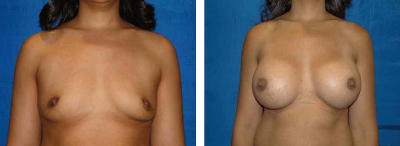 Breast Augmentation Before & After Gallery - Patient 74801847 - Image 1
