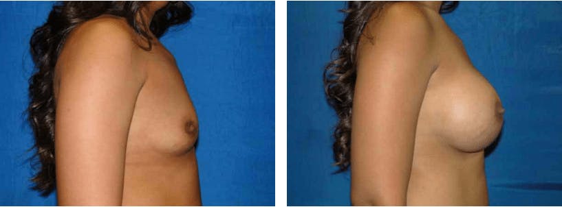 Breast Augmentation Before & After Gallery - Patient 74801847 - Image 2