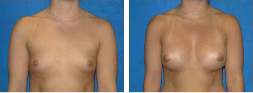 Breast Augmentation Before & After Gallery - Patient 74801848 - Image 1