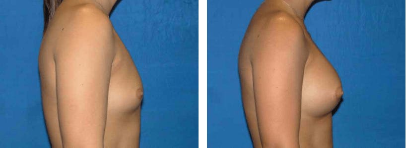 Breast Augmentation Before & After Gallery - Patient 74801848 - Image 2