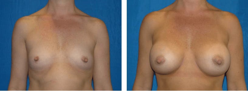 Breast Augmentation Before & After Gallery - Patient 74801849 - Image 1