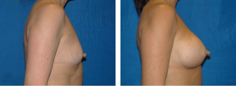 Breast Augmentation Before & After Gallery - Patient 74801849 - Image 2