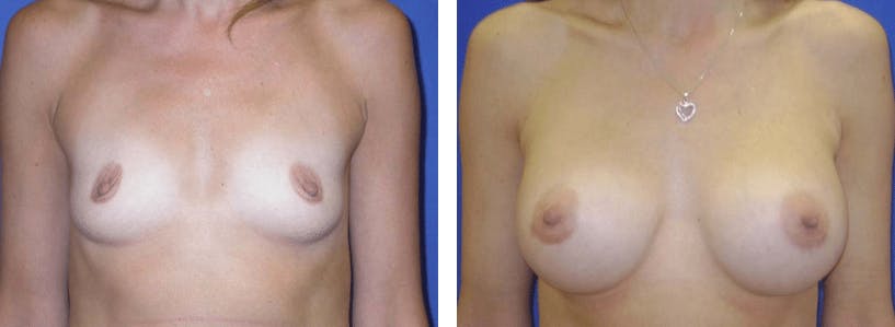 Breast Augmentation Before & After Gallery - Patient 74801851 - Image 1