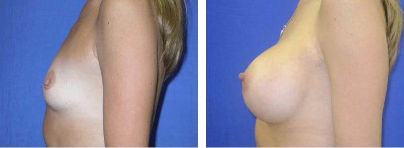 Breast Augmentation Before & After Gallery - Patient 74801851 - Image 2