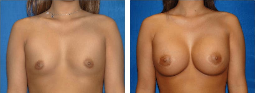 Breast Augmentation Before & After Gallery - Patient 74801856 - Image 1