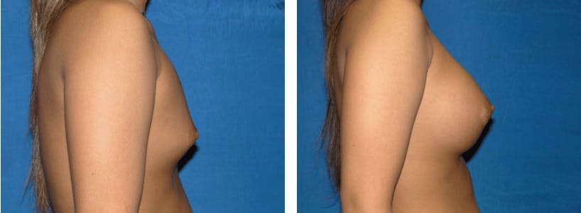 Breast Augmentation Before & After Gallery - Patient 74801856 - Image 2