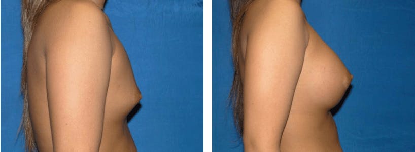 Breast Augmentation Before & After Gallery - Patient 74801856 - Image 2