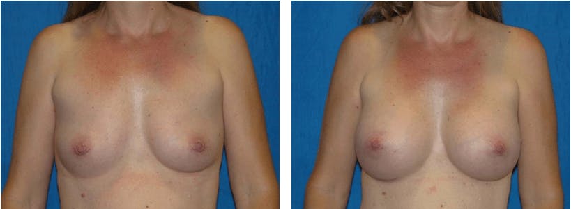 Breast Augmentation Gallery - Patient 74801857 - Image 1