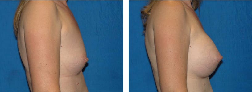Breast Augmentation Before & After Gallery - Patient 74801857 - Image 2