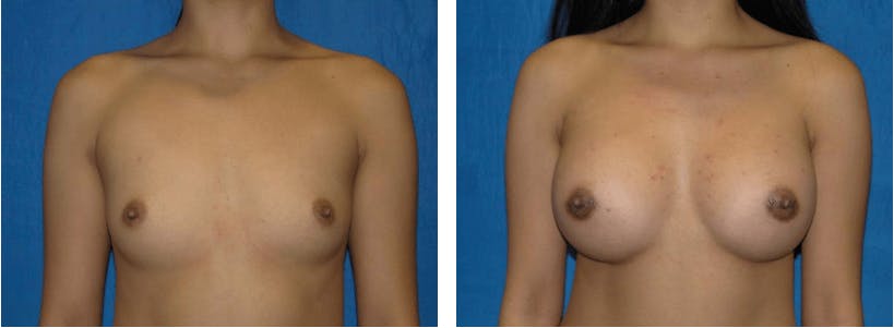 Breast Augmentation Before & After Gallery - Patient 74801858 - Image 1