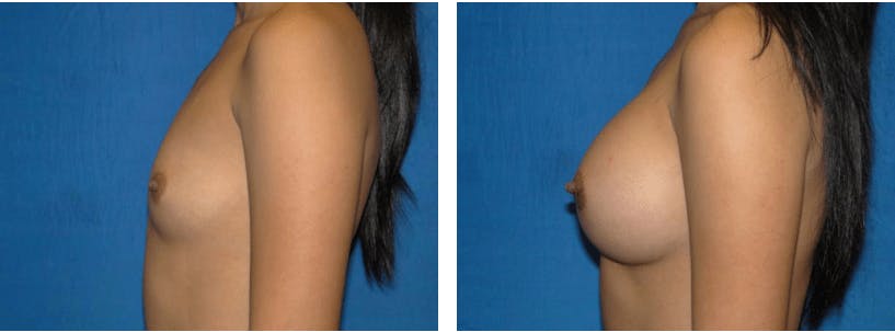 Breast Augmentation Before & After Gallery - Patient 74801858 - Image 2