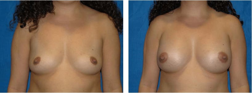 Breast Augmentation Before & After Gallery - Patient 74801859 - Image 1