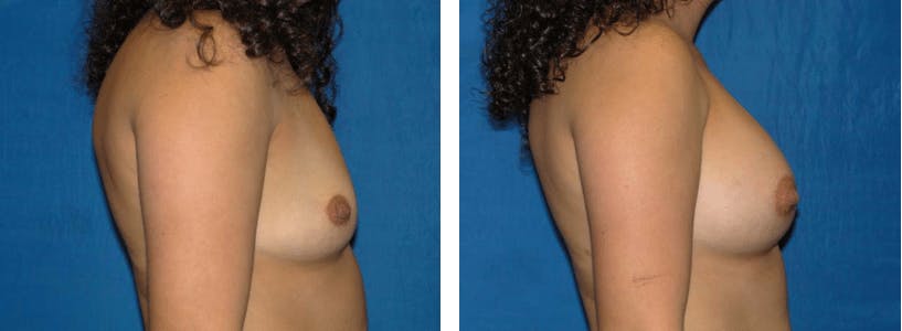Breast Augmentation Before & After Gallery - Patient 74801859 - Image 2